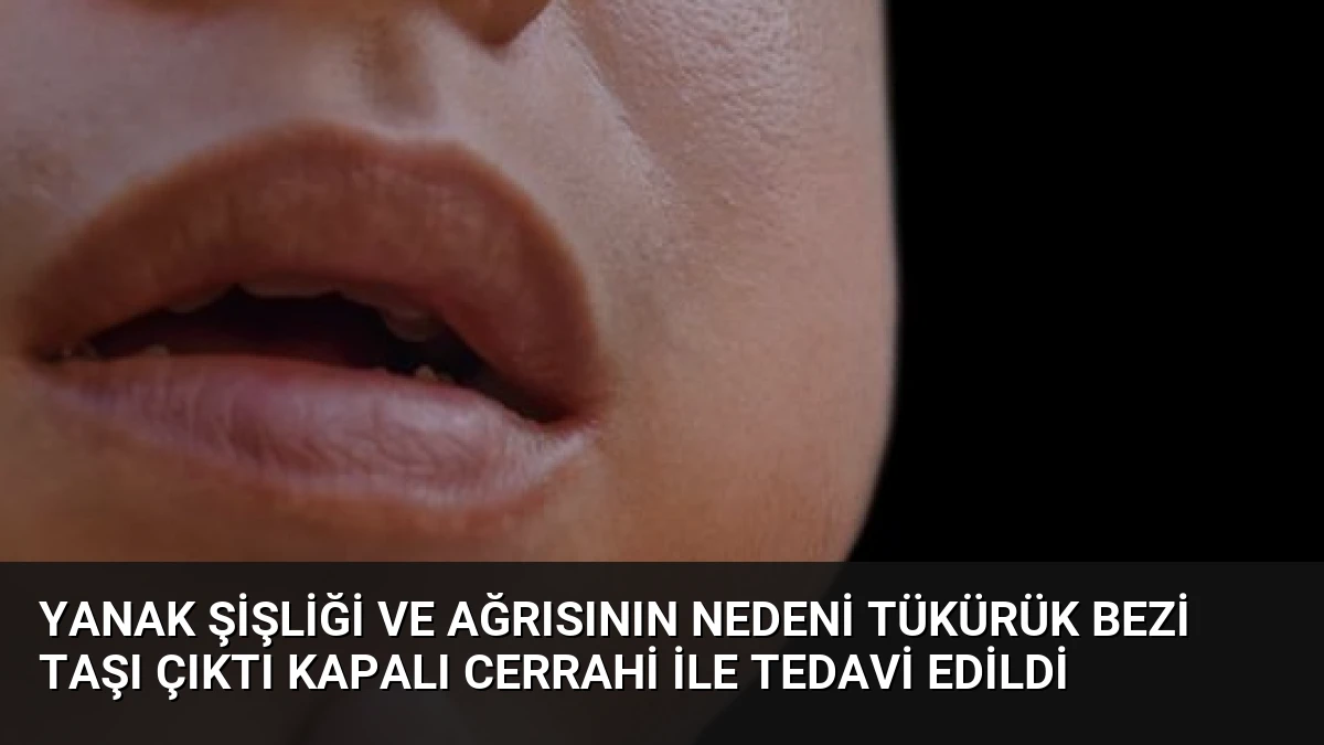 Yanak Şişliği ve Ağrısının Nedeni Tükürük Bezi Taşı Çıktı Kapalı Cerrahi İle Tedavi Edildi